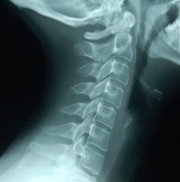 Cervical-Micro-Disc-Surgery-MiSurgical