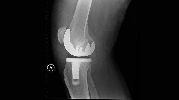 Joint-Replacement-for-Shoulder,-Knee,-and-Hip-MiSurgical