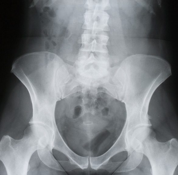 Sacroiliac-(SI)-Joint-Injections-MiSurgical